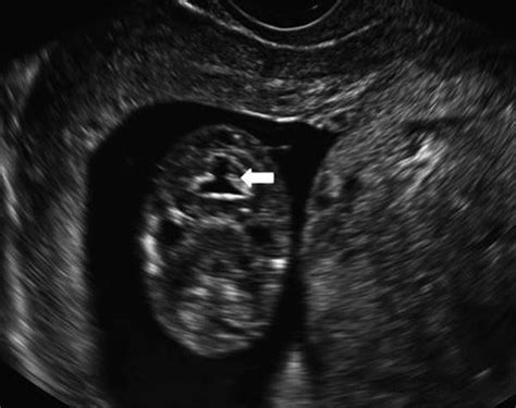 dating ultrasound sogc